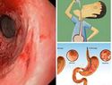 Este eficaz remedio cura la gastritis y la acidez de por vida