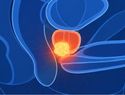Cáncer de próstata: tratamiento en cinco sesiones