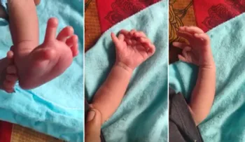 Padres con bebé de 26 dedos creen que se reencarnó en una diosa hindú