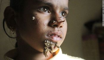 Niña de Bangladesh tiene síndrome del "hombre-árbol"