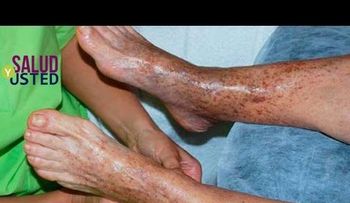 Esta es la solución de 20 minutos para la mala circulación de la sangre!