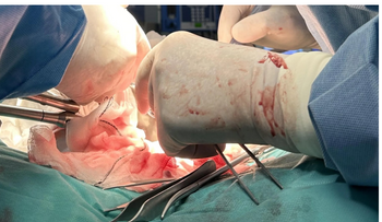 Realizan primer trasplante de riñones porcinos con células humanas