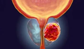 Médicos de AL experimentan con biomarcadores para atender cáncer de próstata
