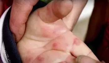 La propagación de la fiebre del tomate en la India provoca una nueva alerta