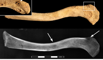 Hallan un cáncer de más de 3.000 años