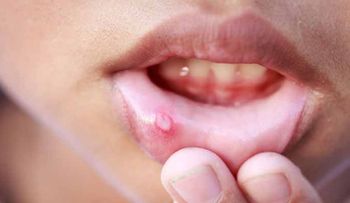 Aftas bucales; causa y prevención 