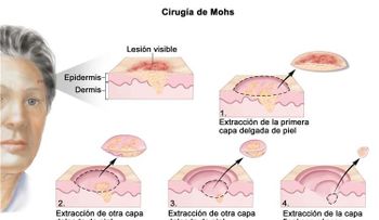 Un nuevo tratamiento para lesiones de la piel