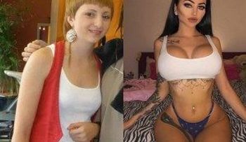 Era víctima del bullying y gastó millones en cirugías para convertirse en modelo top en Instagram