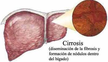Tomar aceite de girasol o pescado puede causar cirrosis y cáncer de hígado