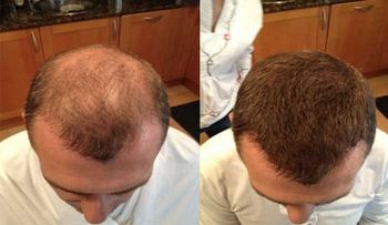 Adiós al peluquín y a los implantes. El pelo en polvo es la â??soluciónâ? a la calvicie (VIDEO)