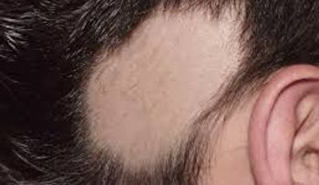 ¿Qué es la alopecia areata y quién puede desarrollar esta enfermedad?