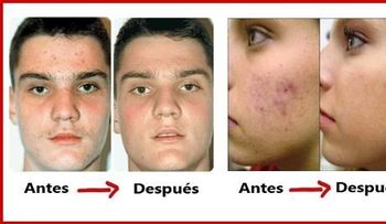 Cura para el acné de forma natural y para siempre