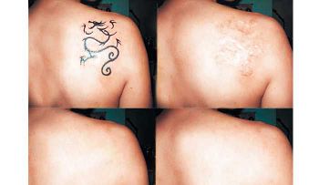 ¿Se pueden quitar los tatuajes sin lesionar la piel?
