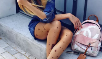 Se burlaban de ella por su enfermedad y ahora es cotizada modelo