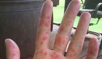 Alertan nuevo virus que afecta niños y adultos; se pega con un esturnudo, beso o apretón de manos