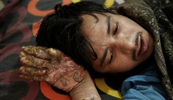 Piden cadena de oración mundial por "hombre árbol",  vuelve al hospital sin esperanza de ser curado