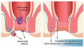 Luego de este remedio no tendrás que ir al quirófano a operar tus hemorroides