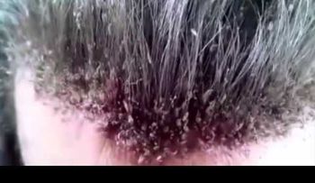 ¡Insólito! Este podría ser el peor caso de un hombre con piojos (VIDEO)