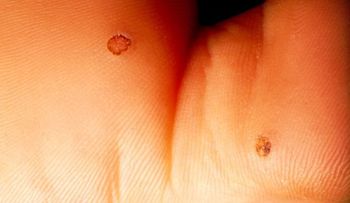 ¿Se puede contagiar el Vírus del Papiloma Humano con el sexo oral?