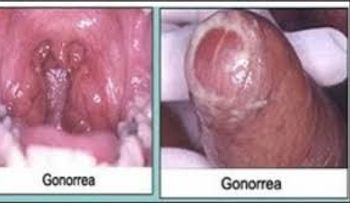 Consecuencias de una gonorrea, explicada por un experto