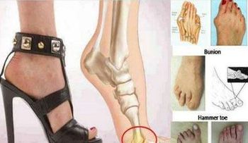 Zapatos de tacón alto causan deformaciones en pies