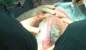 Médicos holandeses implantan por primera vez un cráneo de plástico impreso en 3D