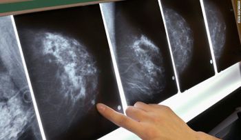 Estudio: Una mamografía con resultado falso positivo es real factor riesgo de cáncer