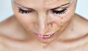 El descuido prematuro de la piel puede ocasionar el padecimiento del Melasma