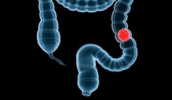 Aprueban examen contra cáncer de colon en EEUU 