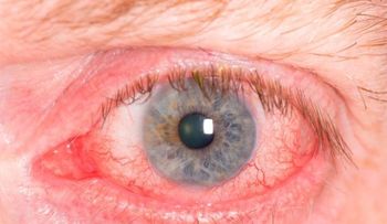  Cómo eliminar naturalmente el enrojecimiento de los ojos. 