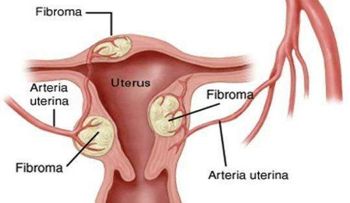 7 señales de advertencia de miomas uterinos