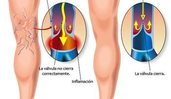  Los ejercicios también sirven para las varices; cuáles son recomendados 