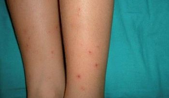 Nicaragua en alerta extrema sanitaria por chikungunya
