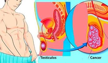 Los síntomas del cáncer testicular para acabar con él antes que se desarrolle 