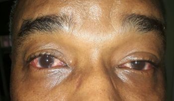 El 8.25% de pacientes consultados ha tenido síntomas de conjuntivitis este año