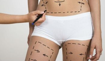 Cinco mitos sobre la liposucción
