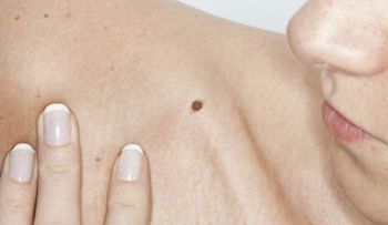 La combinación de dos nuevas moléculas frena el cáncer de ovario 