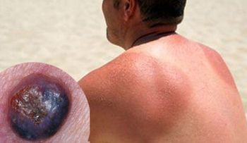 Melanoma, el cáncer de piel más agresivo