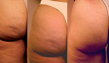 Lo nuevo para lucir una piel suave y libre contra la celulitis