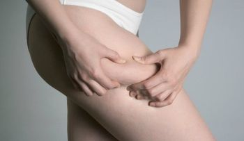 ¿Por qué las mujeres flacas también tienen celulitis?