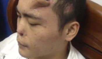 A un hombre le 'crece' una nariz en la frente (Video)