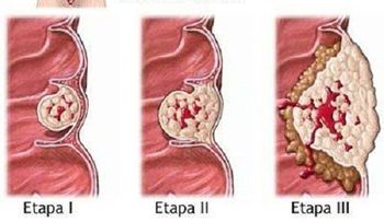 Lo que debes saber sobre el cáncer de colon