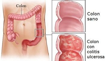 La colitis ulcerosa es una enfermedad crónica del intestino grueso que afecta al colon