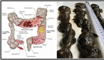 Manzana, jengibre y limón: El más potente limpiador de colon