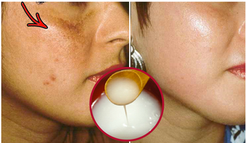 3 Remedios caseros para eliminar las manchas en el rostro