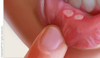 Elimina las aftas (llagas) de tu boca en 2 minutos 