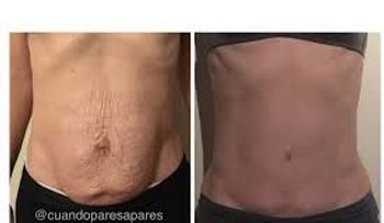 Asegura que 9 de cada 10 mujeres terminan con el hombre que estuvo con ella antes de la lipo