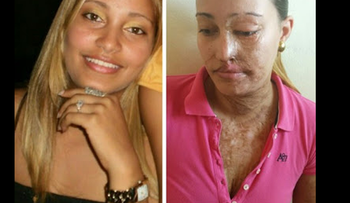 Pide ayuda Estefany Díaz Pena, a quien delincuentes le quitaron la belleza con Acido del Diablo