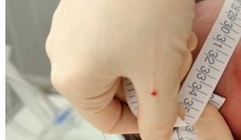 Nace primer bebé con microcefalia por zika en Puerto Rico
