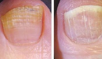 3 ingredientes para eliminar por completo hongos de las uñas 